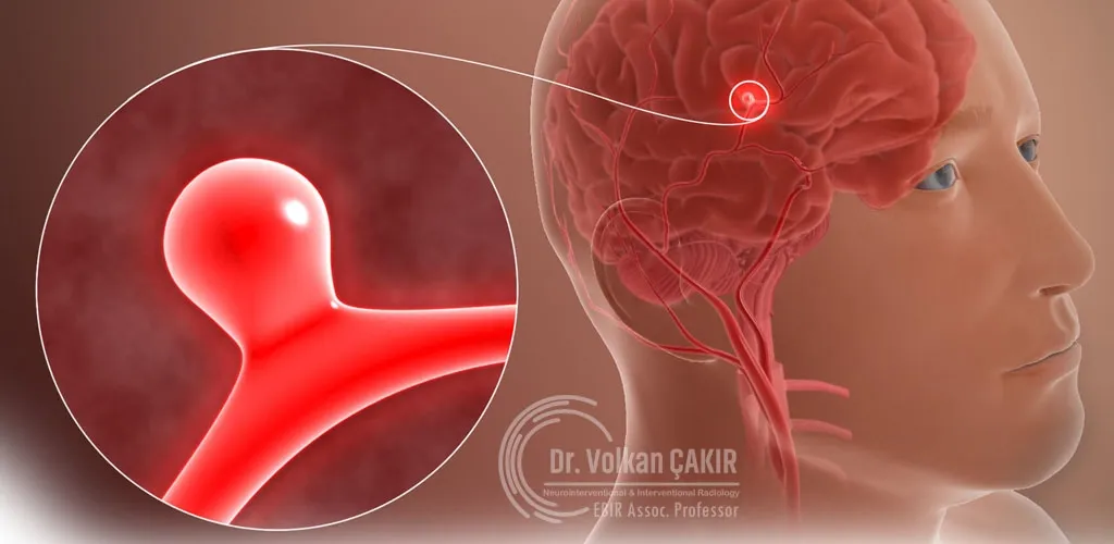 Advanced Endovascular Treatment for Brain Aneurysms 