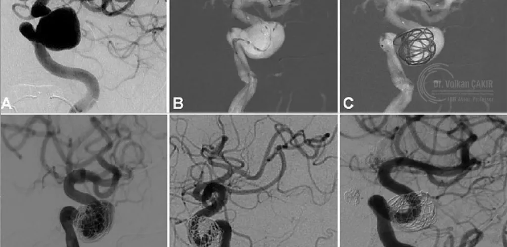 Endovascular Treatment for Complex Intracranial Aneurysms Ajman