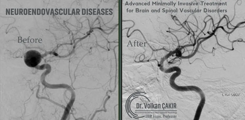Neuroendovascular Diseases Dibba