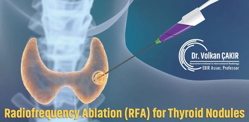 Radiofrequency Ablation (RFA) for Thyroid Nodules Dubai